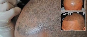 Micro hair tattoo procedure32