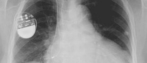 Pacemaker radiografia cuore hacker