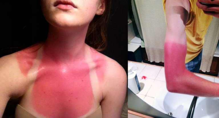 Queste persone dovrebbero imparare a mettersi la crema solare