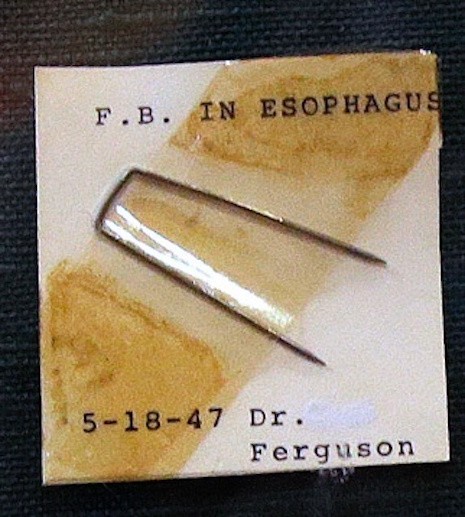 Gli oggetti più strani ingoiati dai bambini