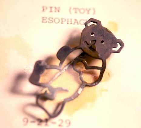 Gli oggetti più strani ingoiati dai bambini