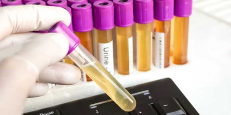 Schiuma nelle urine, problema