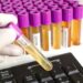 Schiuma nelle urine, problema