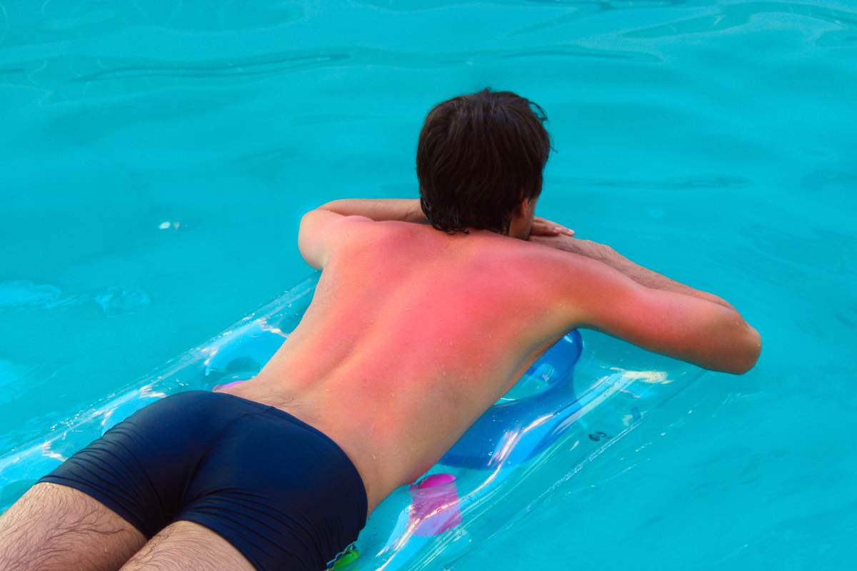 dermatiti estive