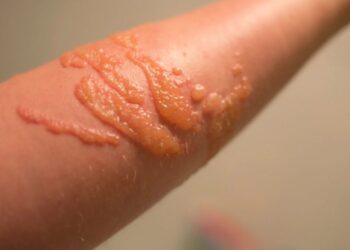 Morso meduse, cosa fare