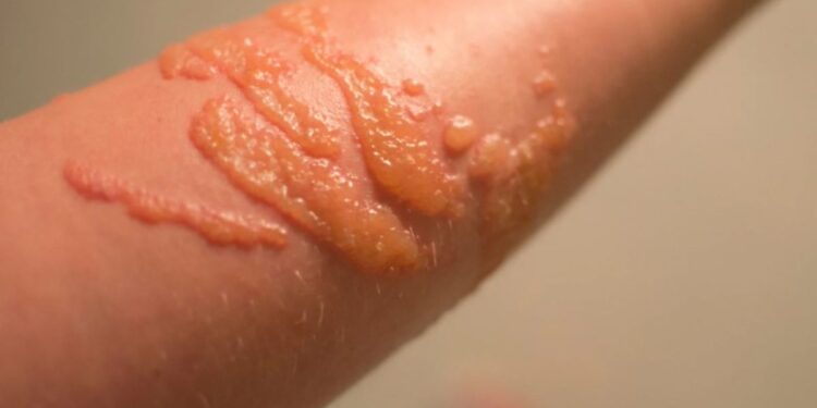 Morso meduse, cosa fare