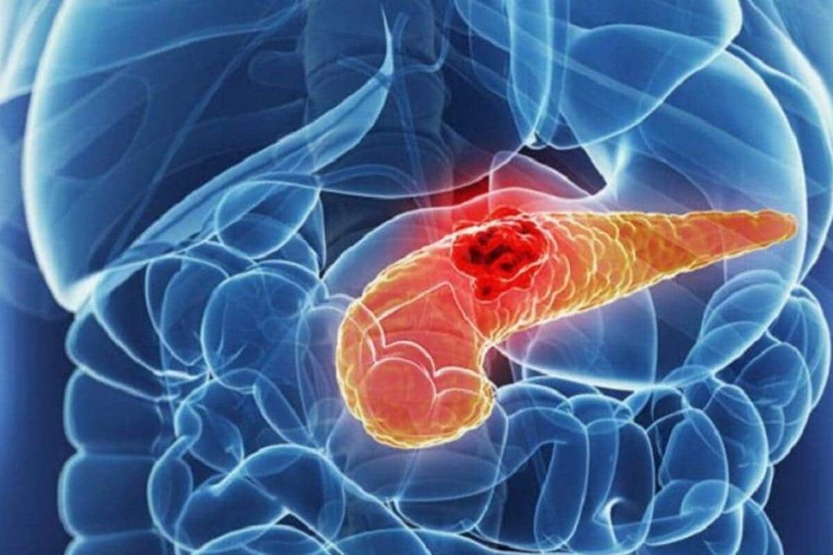 Una immagine che mostra graficamente un pancreas ammalato.